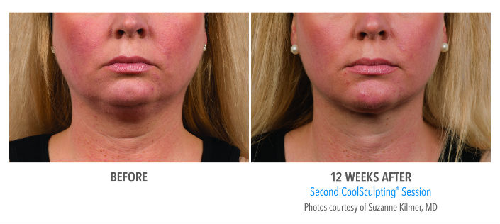Before---After-chin-resize.jpg
